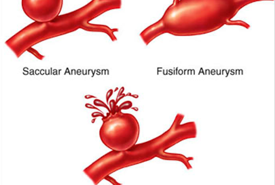 Aneurisma